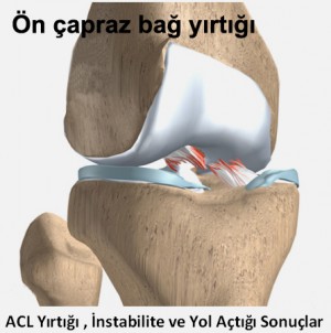 Ön çapraz bağ kopukluğu