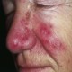 Rosacea, Roza, Gül Hastalığı