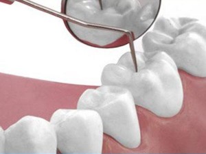 Diş dolgusu nedir? Dolgu türleri nelerdir?